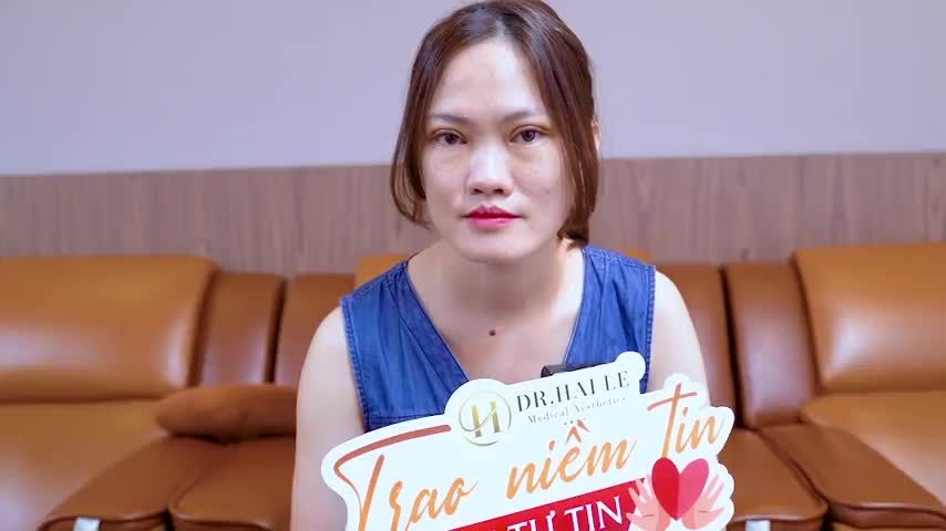 Khuôn mặt xinh đẹp, đôi mắt rạng rỡ chỉ sau 7 ngày thực hiện Cắt mí tại Dr.Hải Lê