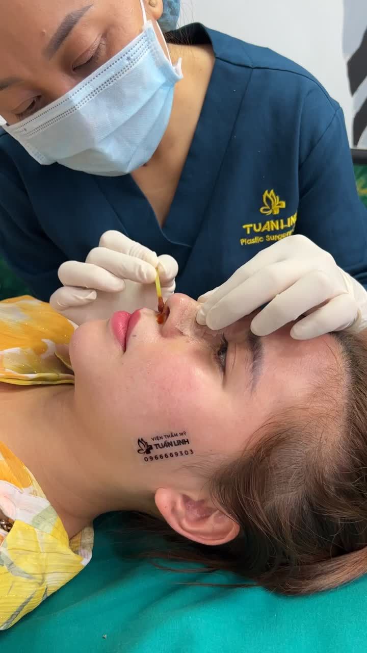 Combo mũi cấu trúc + cằm Vline thay đổi cả khuôn mặt sau 10 ngày tháo nẹp, tái khám