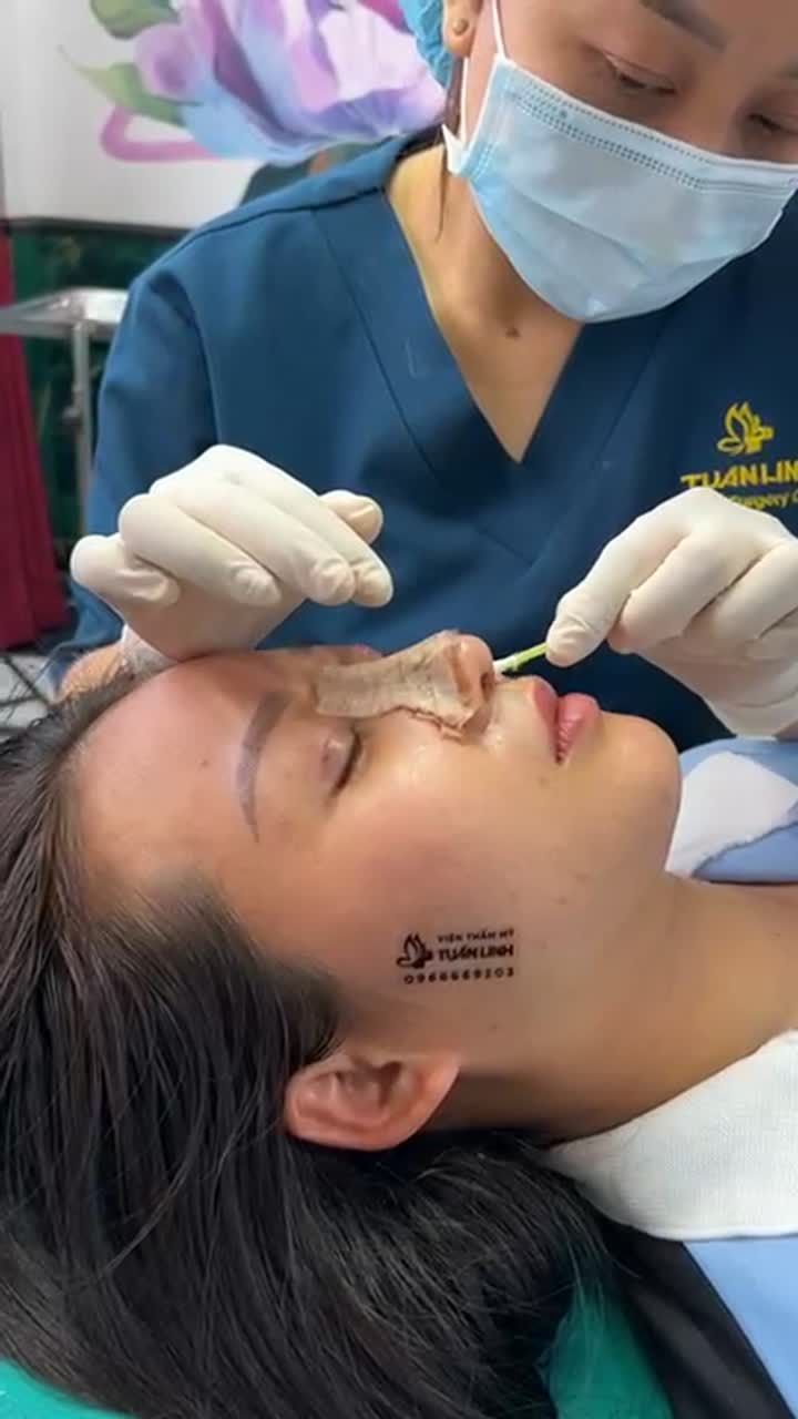 Mũi đẹp tự nhiên sau 10 ngày cho chị gái đến từ Phú Yên