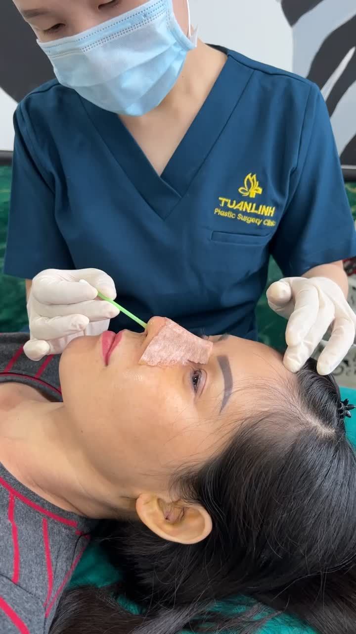 DÁNG MŨI ỔN ĐỊNH SAU 6 NGÀY NÂNG SIÊU CẤU TRÚC SURGIFORM.