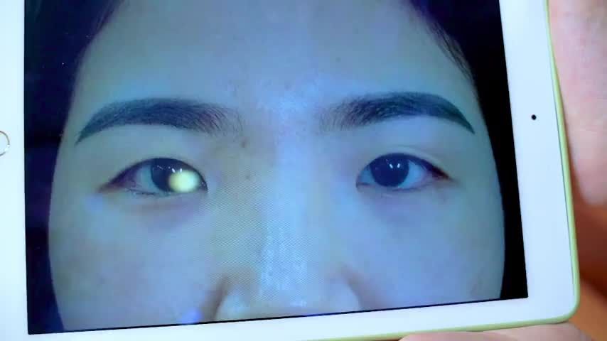 Mắt một mí nhỏ thiếu tự tin bạn có thể đến Dr.Hải Lê để có giải pháp sở hữu mắt 2 mí tươi trẻ rạng rỡ