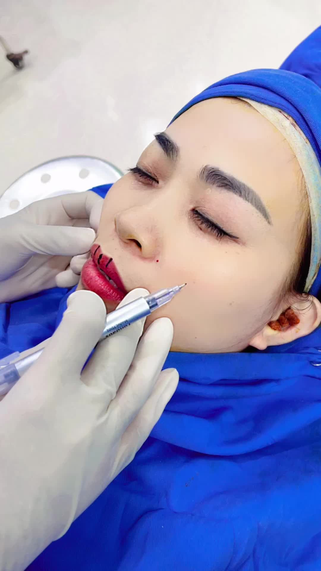 Lắng nghe chia sẻ phương pháp phẫu thuật tối ưu Combo Nâng mũi - Tạo hình môi