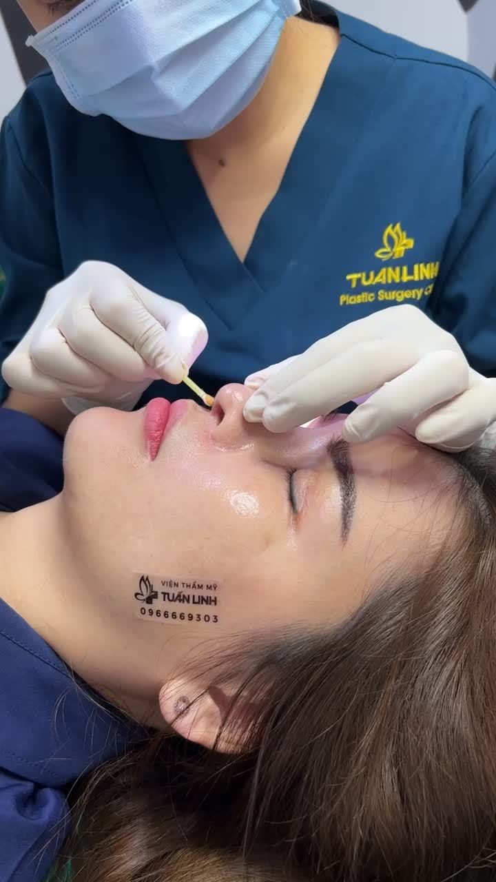 Nâng mũi siêu cấu trúc sụn surgiform tái khám + cắt chỉ sau 10 ngày.
