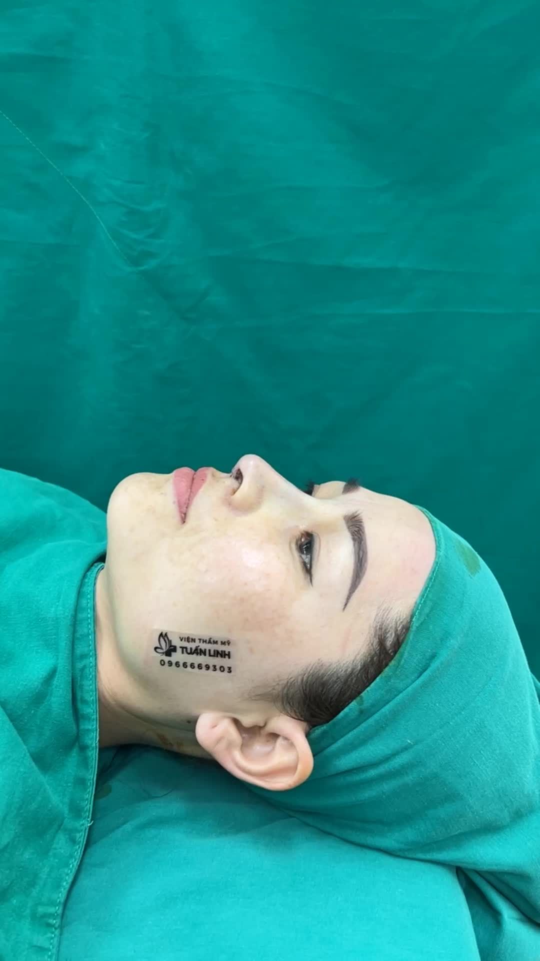 Case Nâng mũi Siêu cấu trúc Surgiform cho chị gái đến từ Khánh Hoà