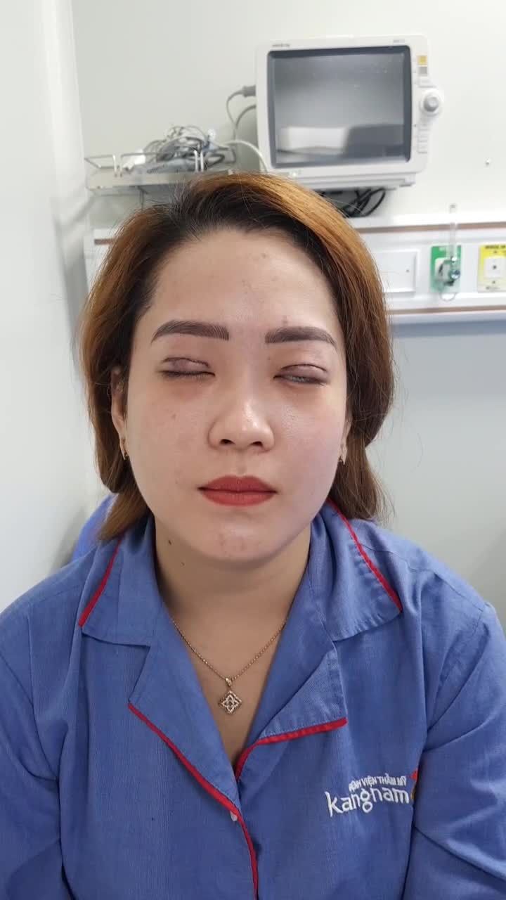 Cắt mí trên Hàn Quốc plasma và cái kết...