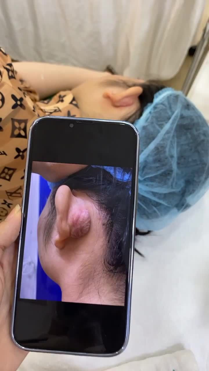 Kết quả bất ngờ phẫu thuật sẹo lồi