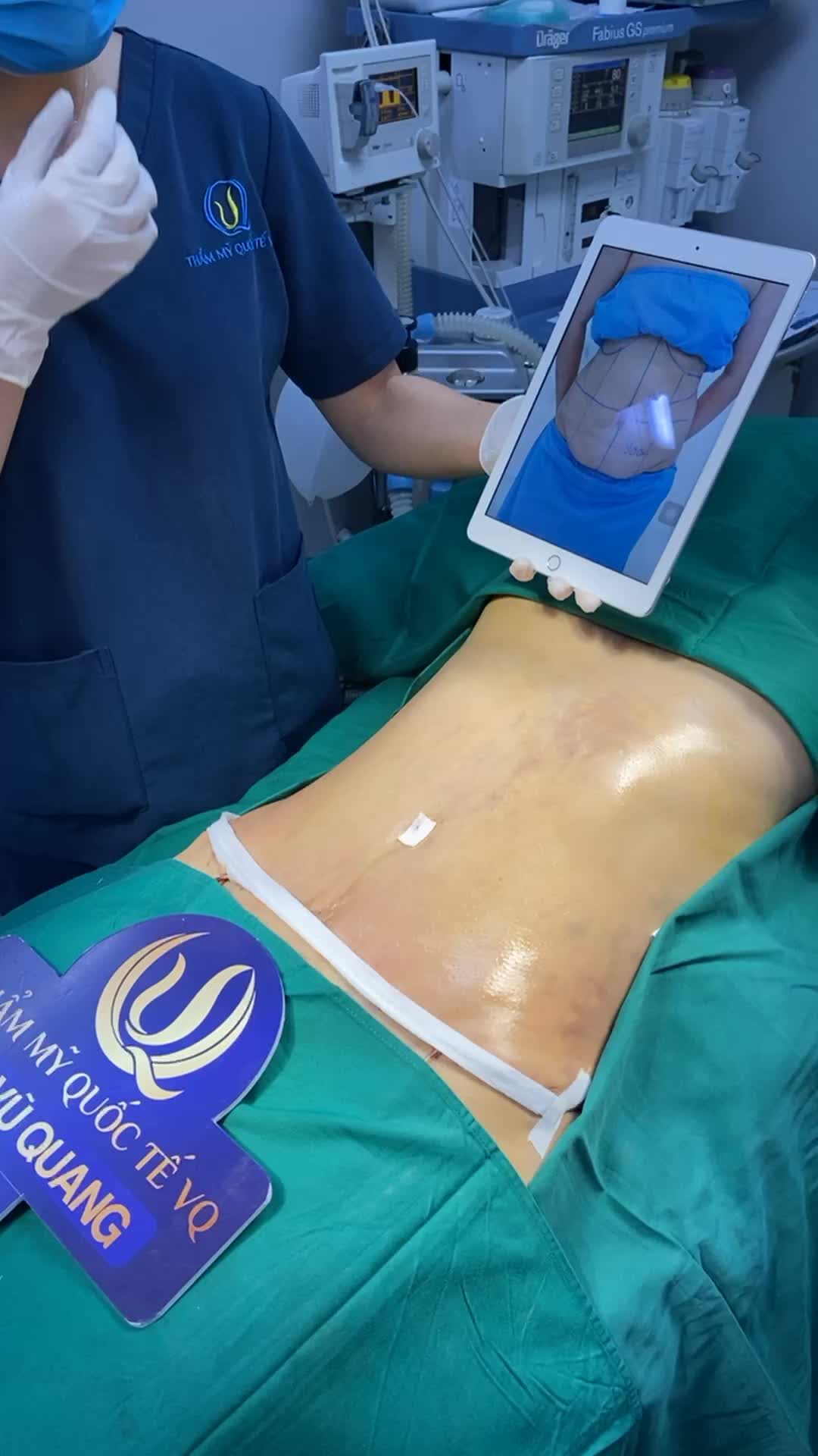 Kết quả Combo Hút mỡ Bụng + Tạo Hình thành bụng cho bà mẹ 2 con.