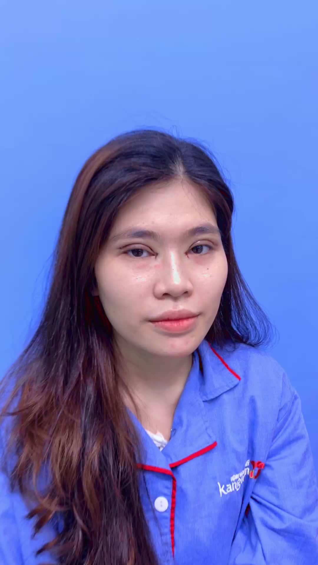 TXem kết quả Cắt mí + Tạo khóe Hết 1 mí mắt nhỏ ngắn