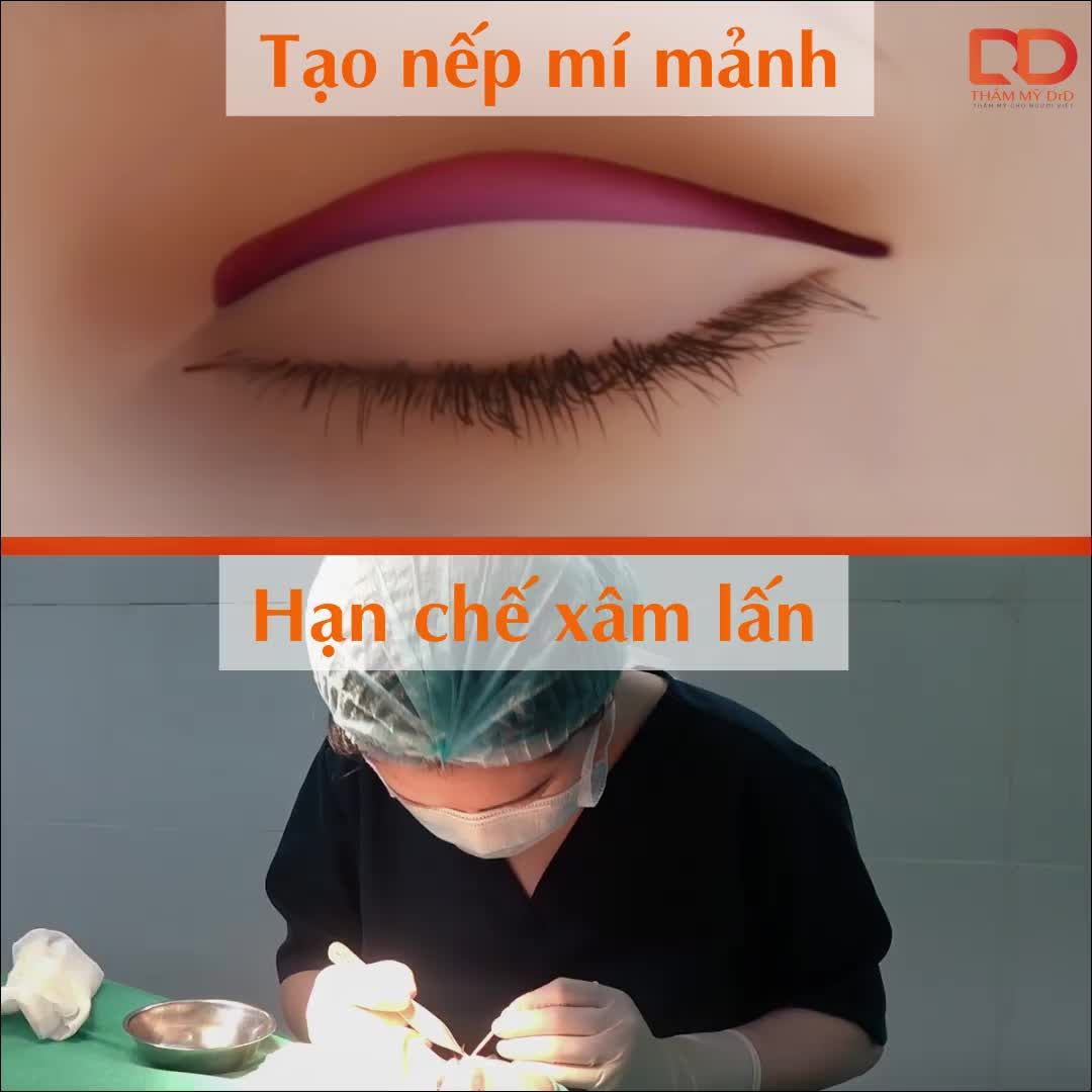 Cắt mí KHÔNG BẦM TÍM Chọn ngay CẮT MÍ ELITE EYES
