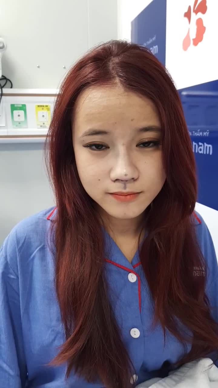 Sau nâng mũi - Hóa hotgirl tại BVTM Kangnam Sài Gòn 666 Cách Mạng Tháng 8