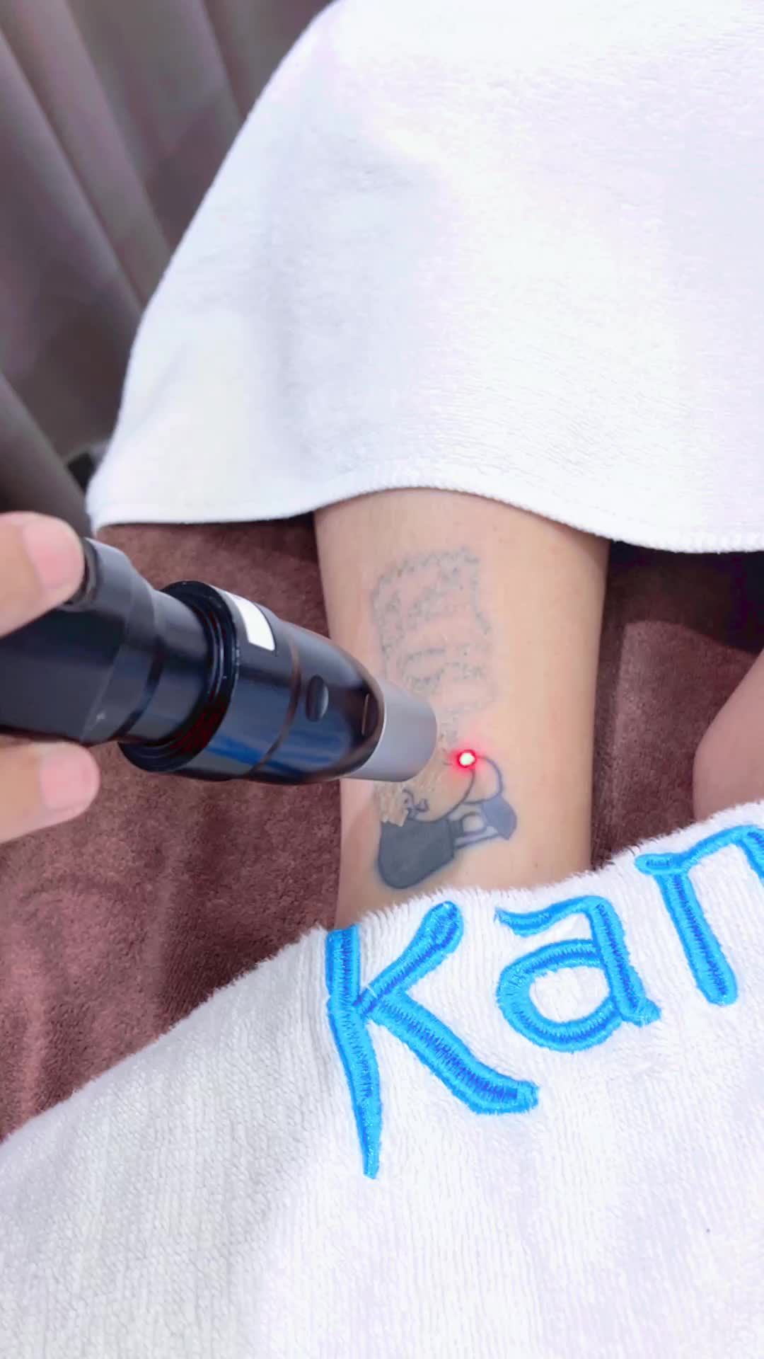 Cận cảnh xoá xăm bằng công nghệ Laser Picosure