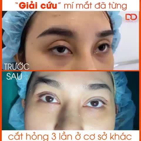 Giải cứu thành công ca cắt mí đã từng cắt hỏng 3 lần ở cơ sở khác và bạn đã phải chờ rất lâu để can thiệp chỉnh sửa.