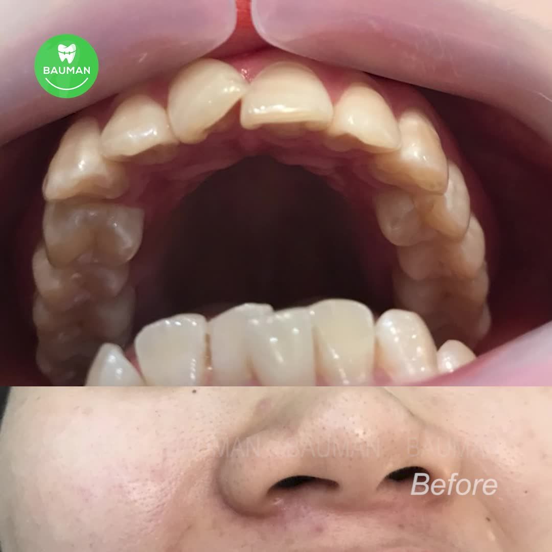 Ca niềng răng 5247| Nha Khoa Bauman