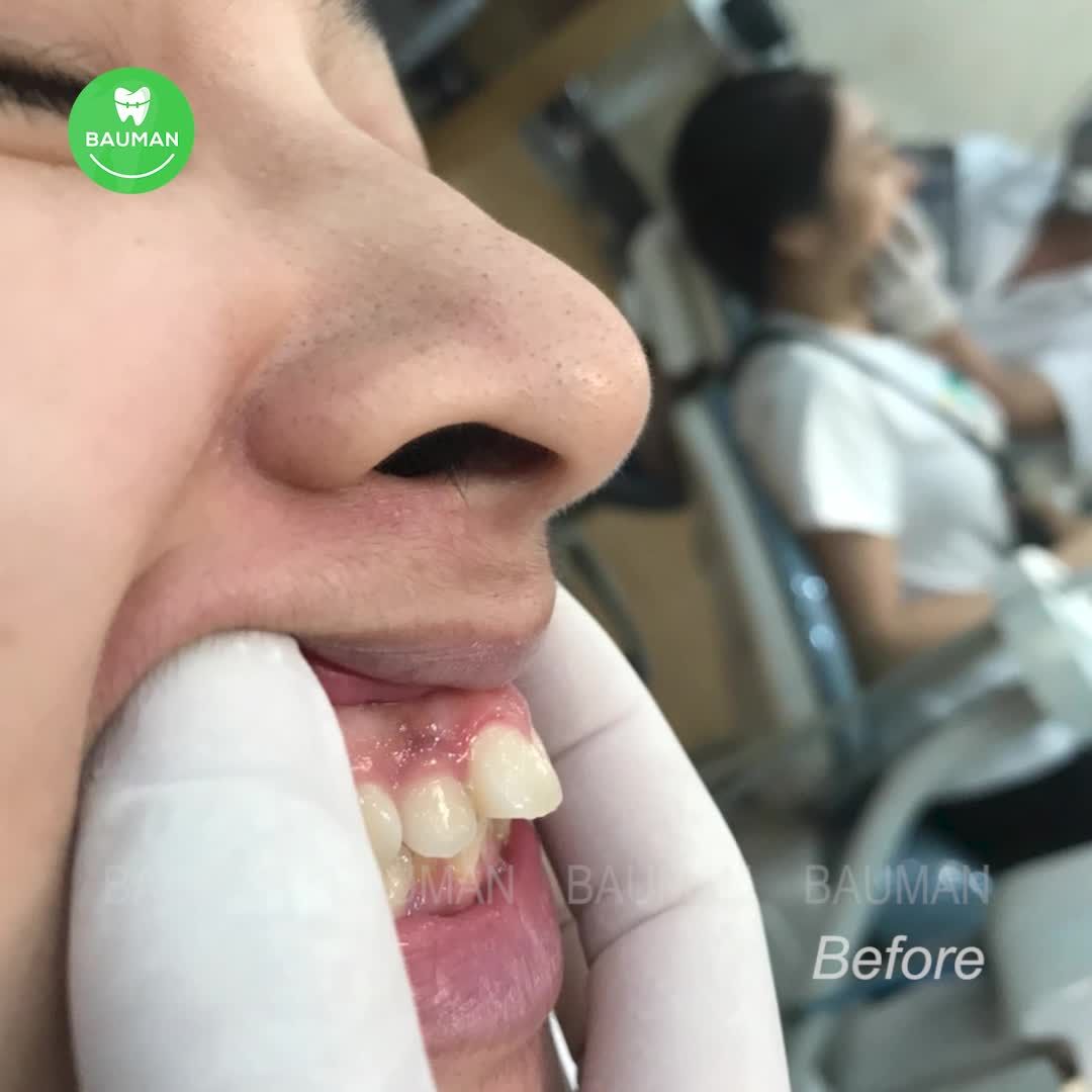 Ca niềng răng 5248| Nha Khoa Bauman