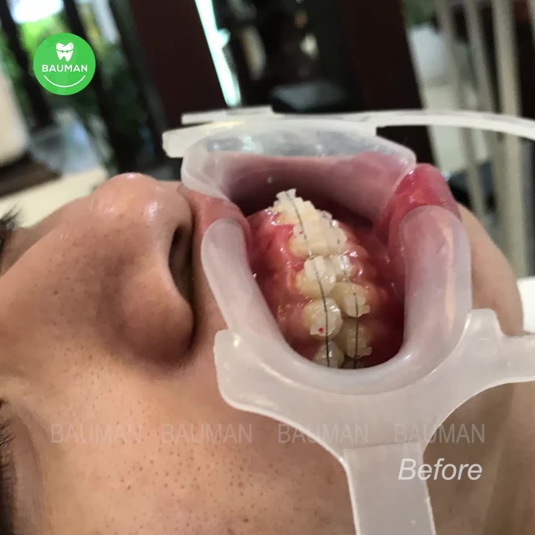 Ca niềng răng 5249| Nha Khoa Bauman