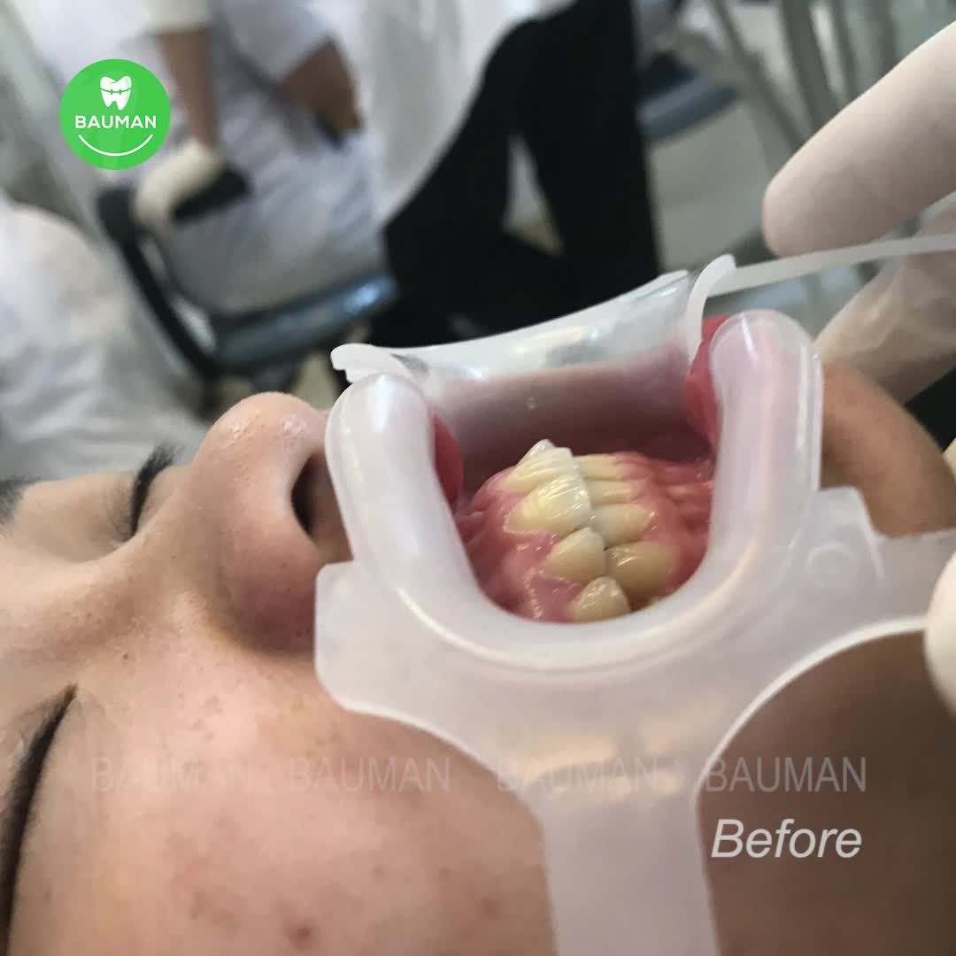 Ca niềng răng 5250| Nha Khoa Bauman