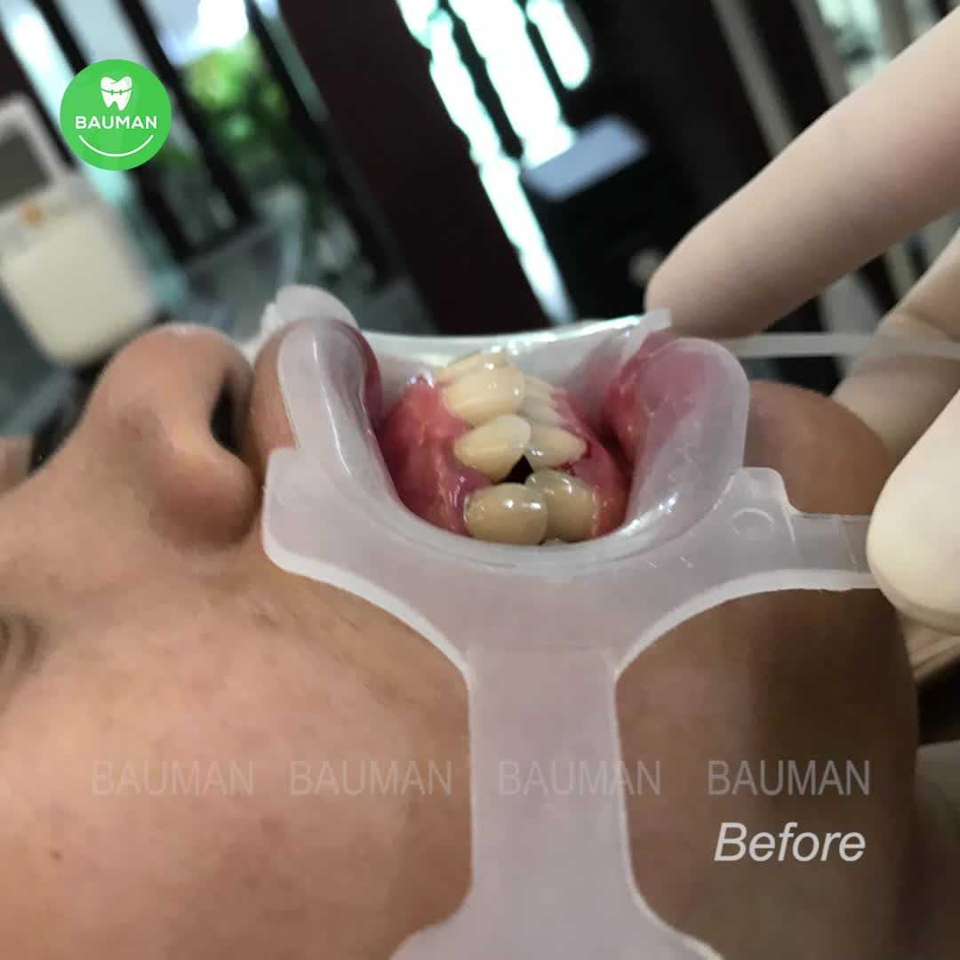 Ca niềng răng 5252| Nha Khoa Bauman