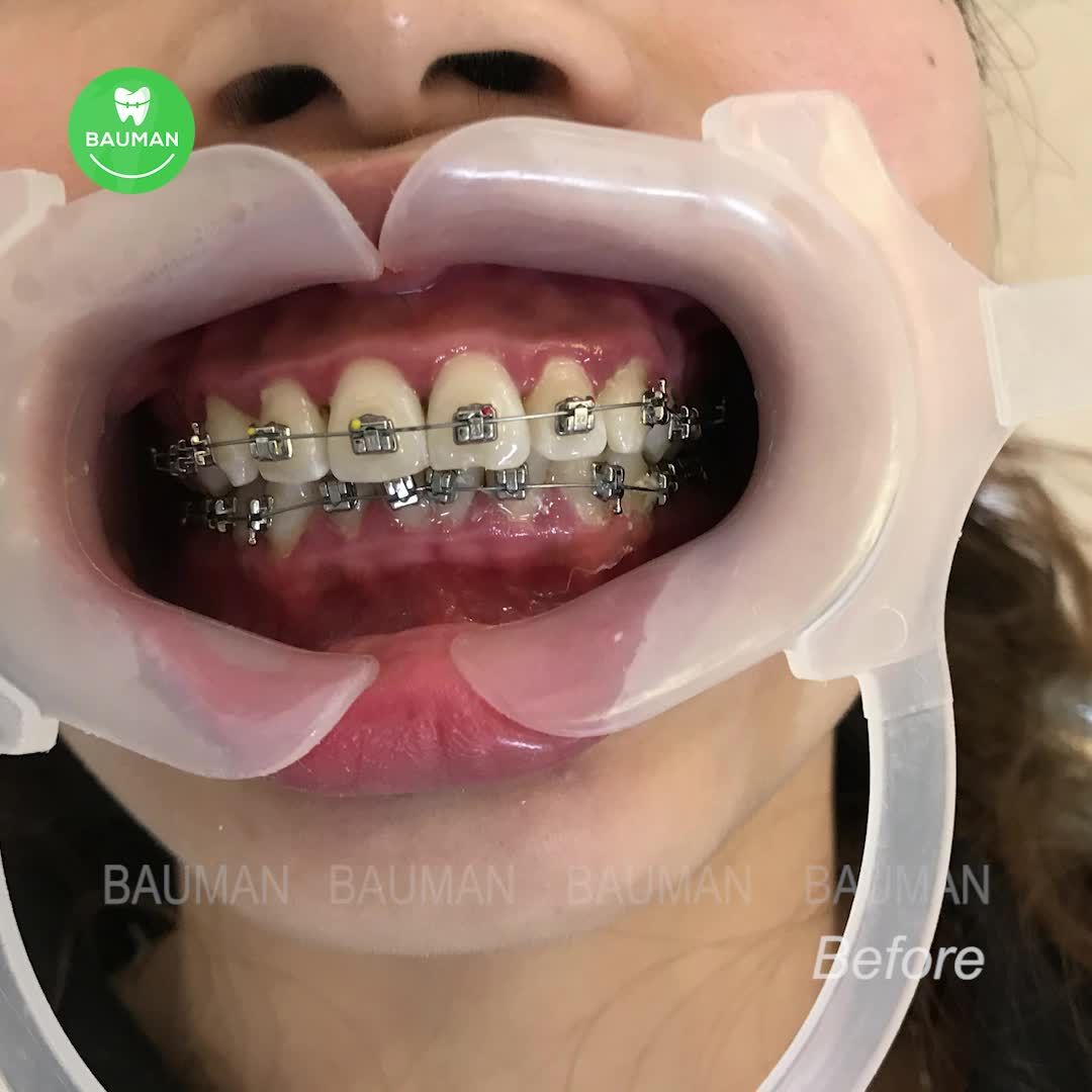 Ca niềng răng 5253| Nha Khoa Bauman