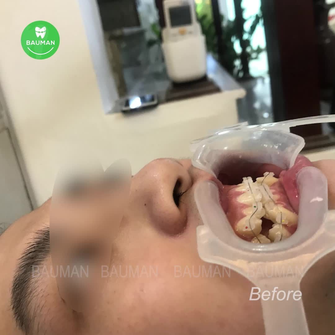 Ca niềng răng 5254 | Nha Khoa Bauman