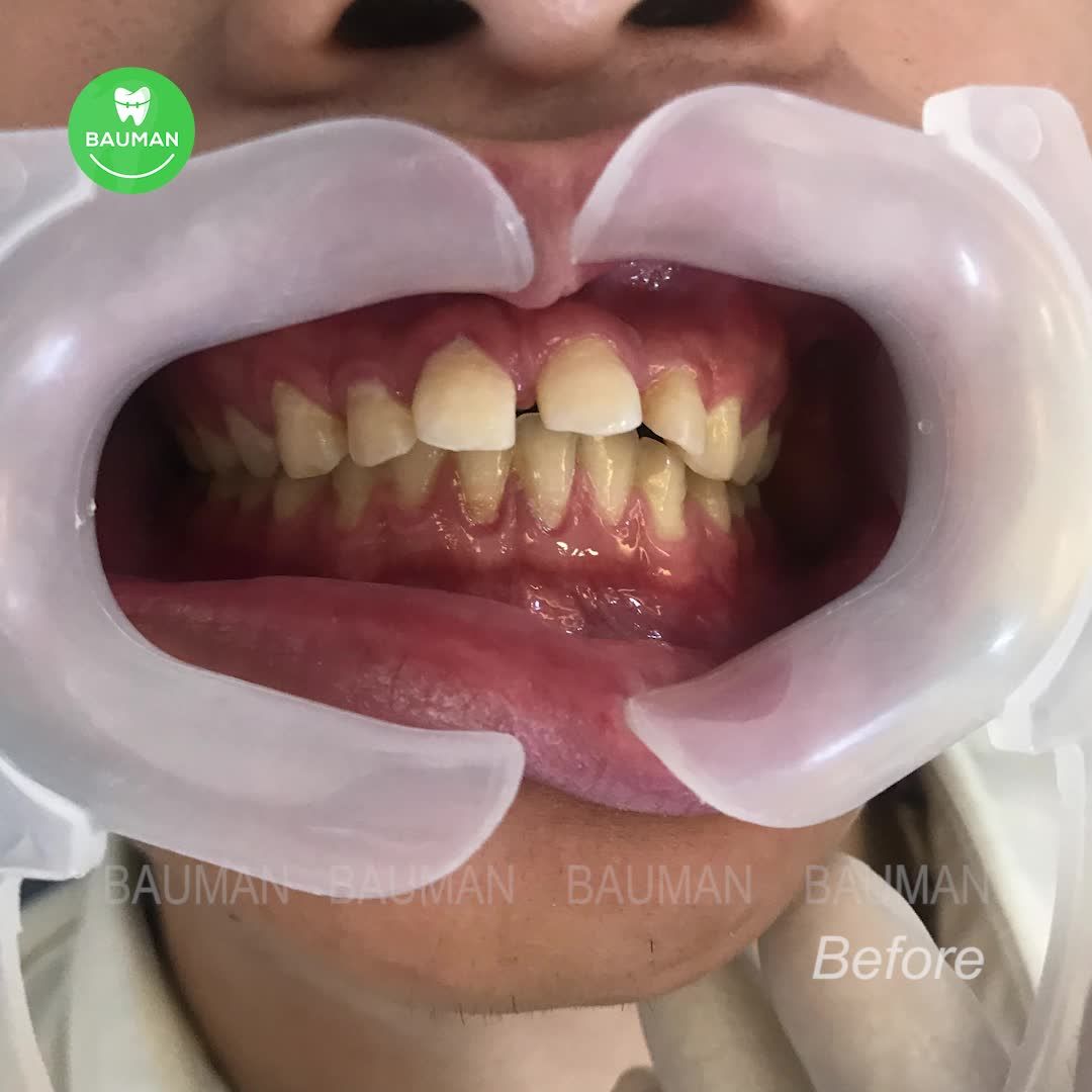 Ca niềng răng 5256| Nha Khoa Bauman