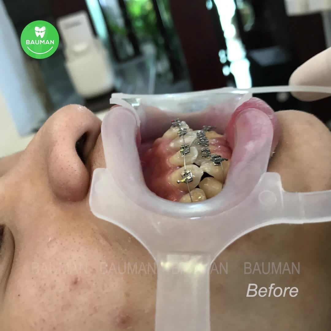 Ca niềng răng 5257 | Nha Khoa Bauman