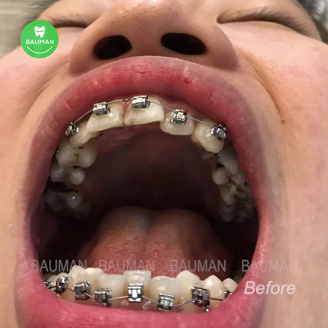 Ca niềng răng 5258 | Nha Khoa Bauman