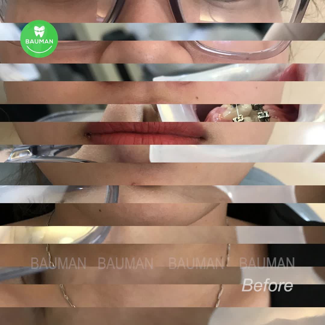 Ca niềng răng 5259| Nha Khoa Bauman