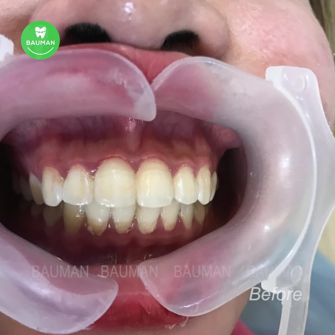 Ca niềng răng 5260 | Nha Khoa Bauman