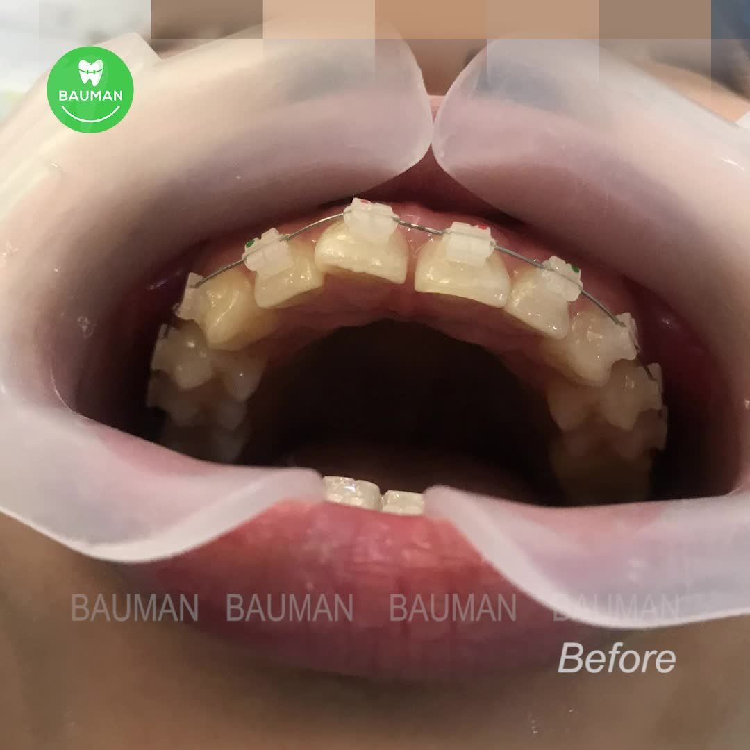 Ca niềng răng 5261| Nha Khoa Bauman