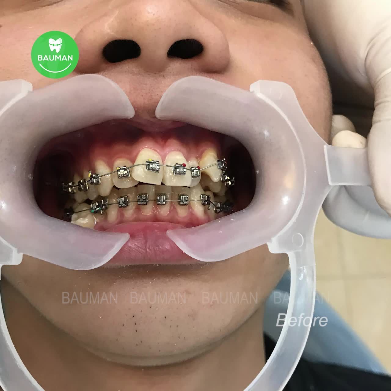 Ca niềng răng 5262| Nha Khoa Bauman