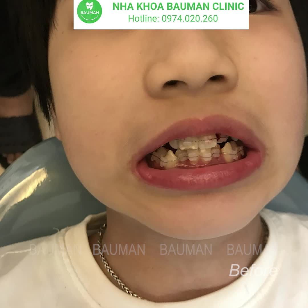 Ca niềng răng 5263 | Nha Khoa Bauman