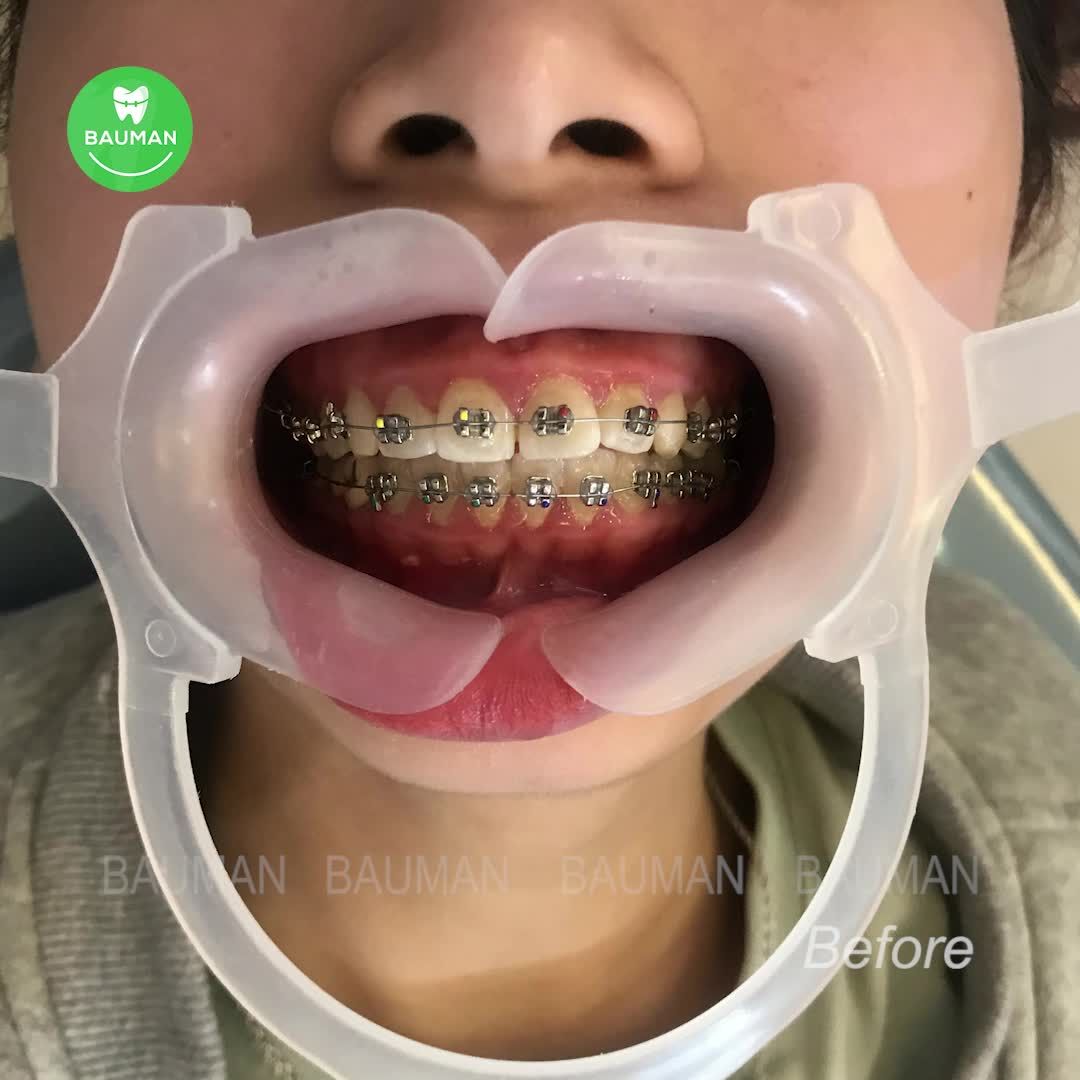 Ca niềng răng 5264 | Nha Khoa Bauman