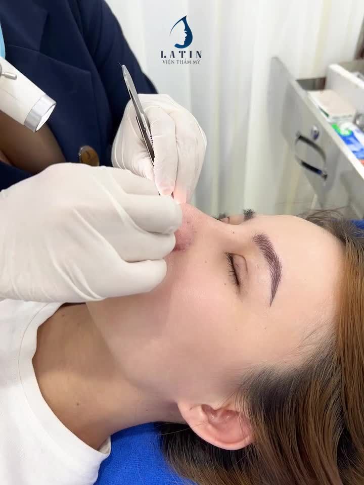 Khách đến tái khám và cắt chỉ Combo mũi bán cấu trúc, thu nền xương, bọc lót Megaderm và cắt mí 4D