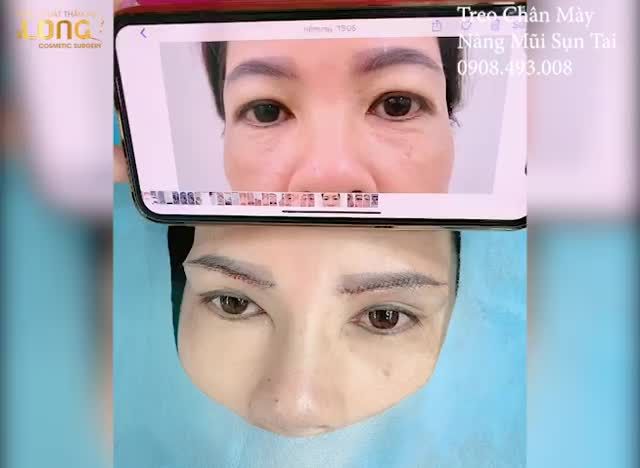 TREO CHÂN MÀY + NÂNG MŨI SỤN