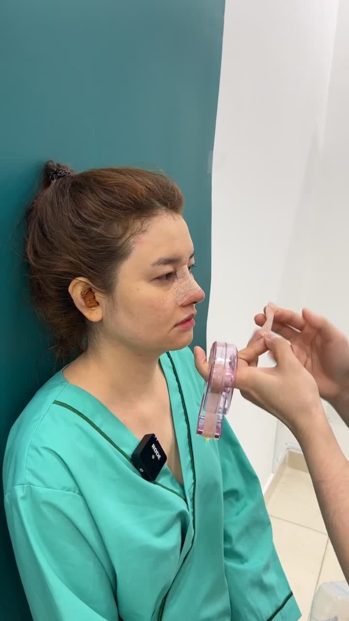 Case nâng mũi siêu cấu trúc sụn Surgiform vừa hoàn thành tại Tuấn Linh đây ạ.