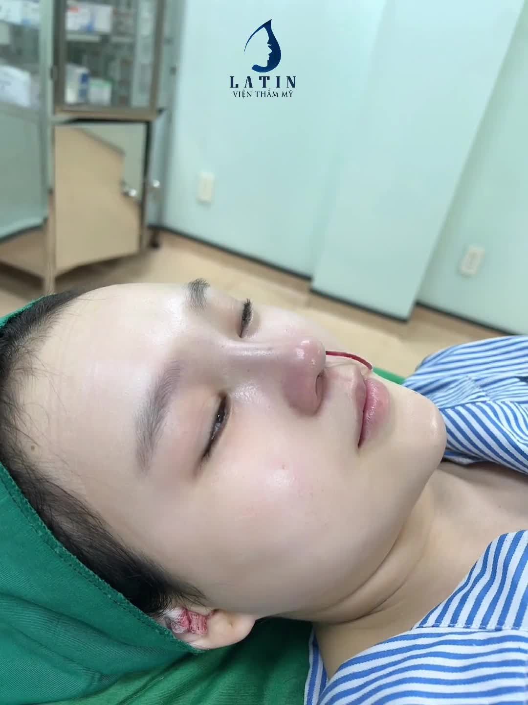 Chiếc mũi đẹp cho em gái đến từ Tiền Giang