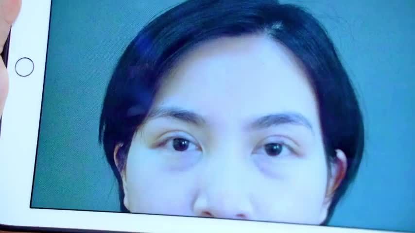 Khách hàng rất vui khi đã rũ bỏ được đôi mắt lỗi hỏng để đổi lấy đôi mắt tự nhiên sau khi sửa mí tại Dr.Hải Lê