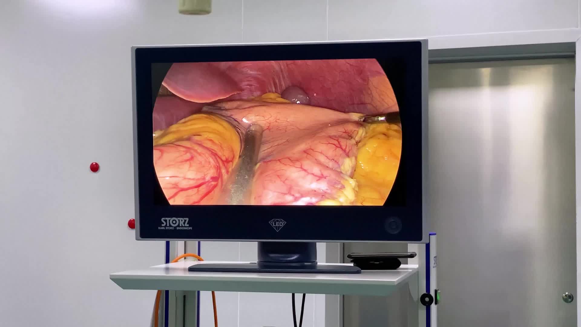 Ưu điểm của hệ thống Cắt - Nối tự động hóa được sử dụng trong phẫu thuật nội soi Thu nhỏ Dạ dày giảm béo