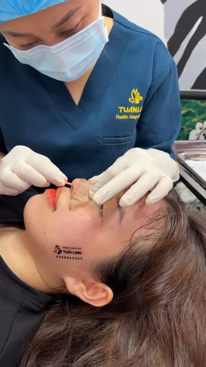 Khoe mũi xinh sau 10 ngày tháo nẹp tại Tuấn Linh