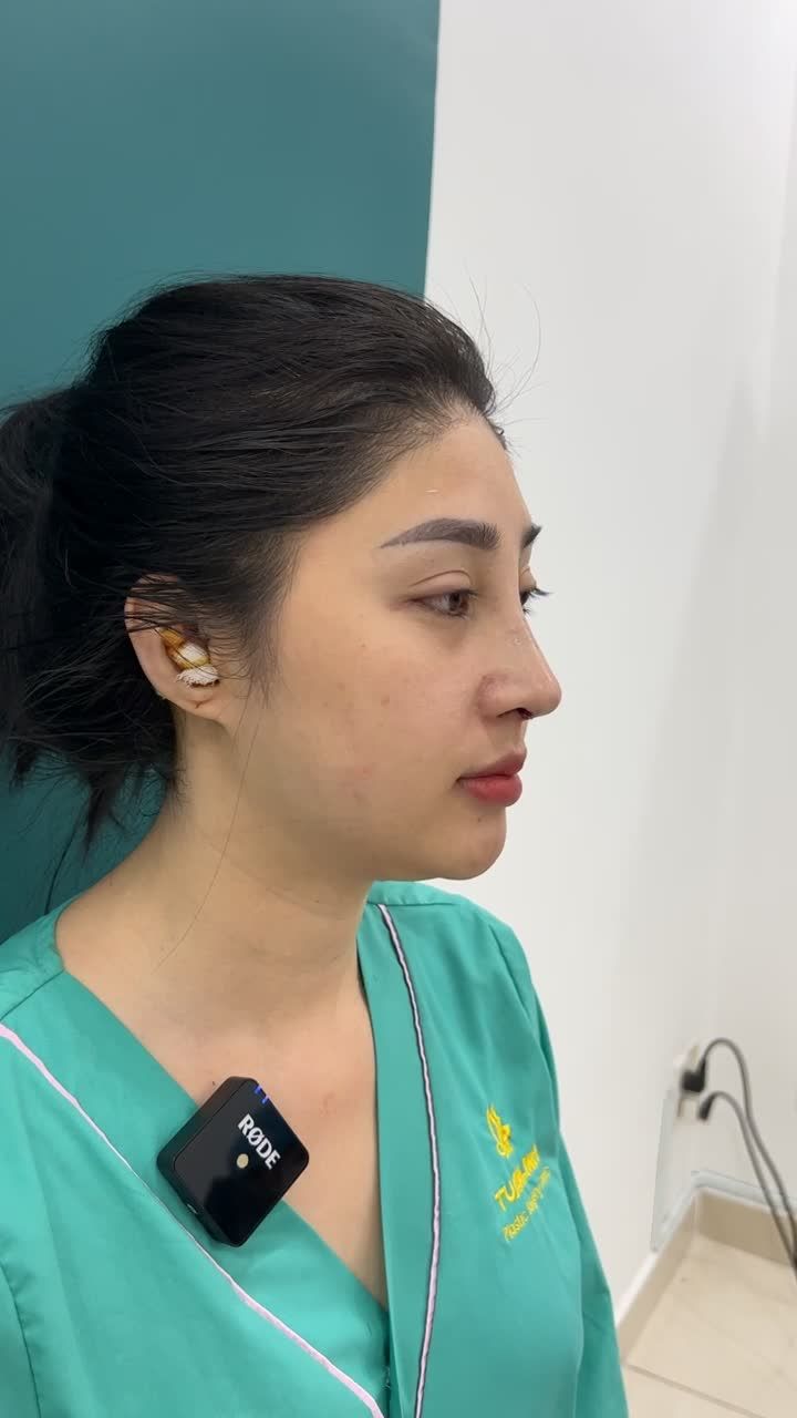 Case Nâng mũi cấu trúc + bọc megaderm hoàn thành sau 90 phút.