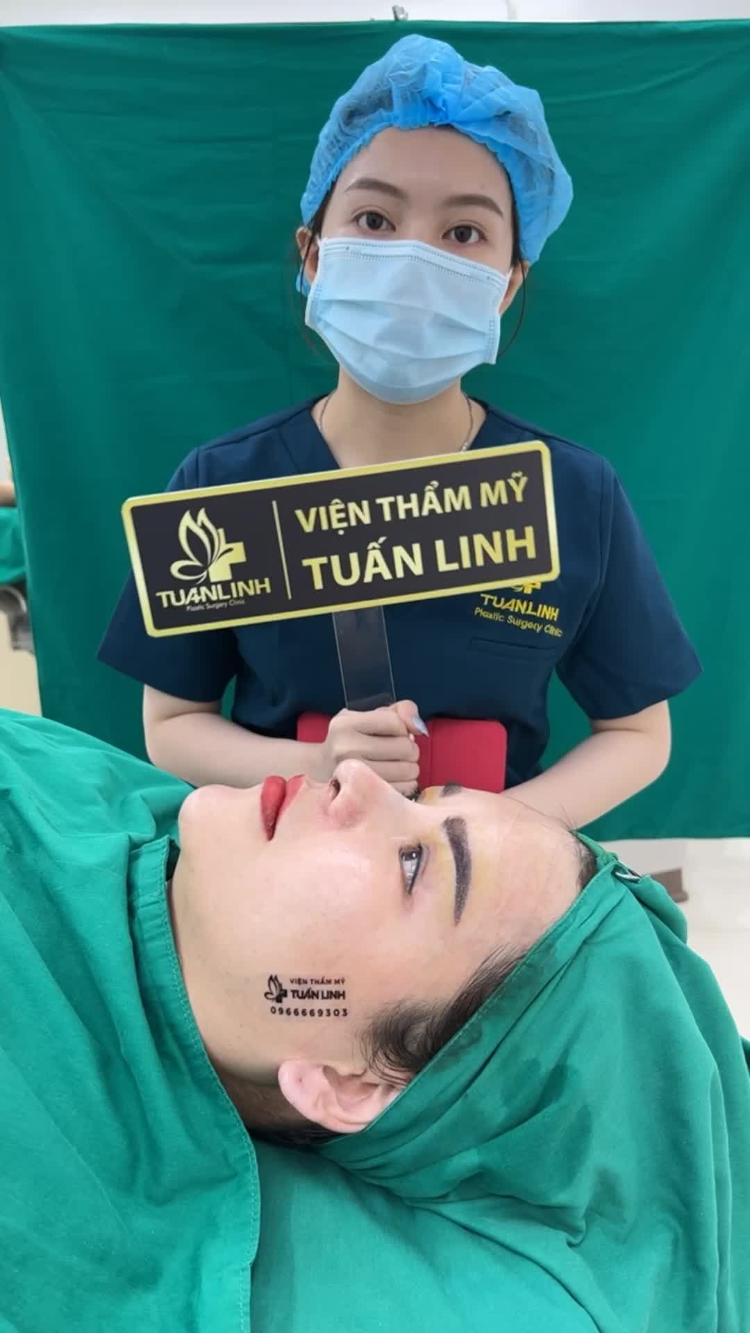 Case Nâng mũi siêu cấu trúc sửa lại + sụn surgiform + tiêm filler cằm cho chị khách đến từ Đài Loan