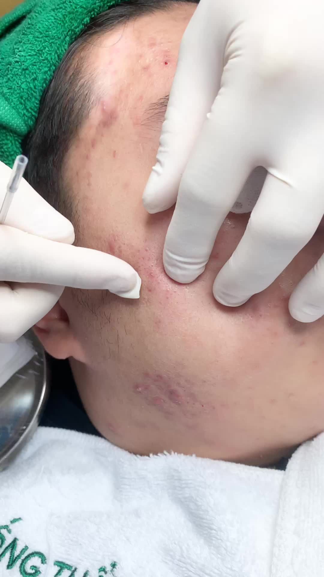Quá trình điều trị mụn bằng công nghệ Nano Acne Plus tại Bệnh viện thẩm Mỹ Đông Á