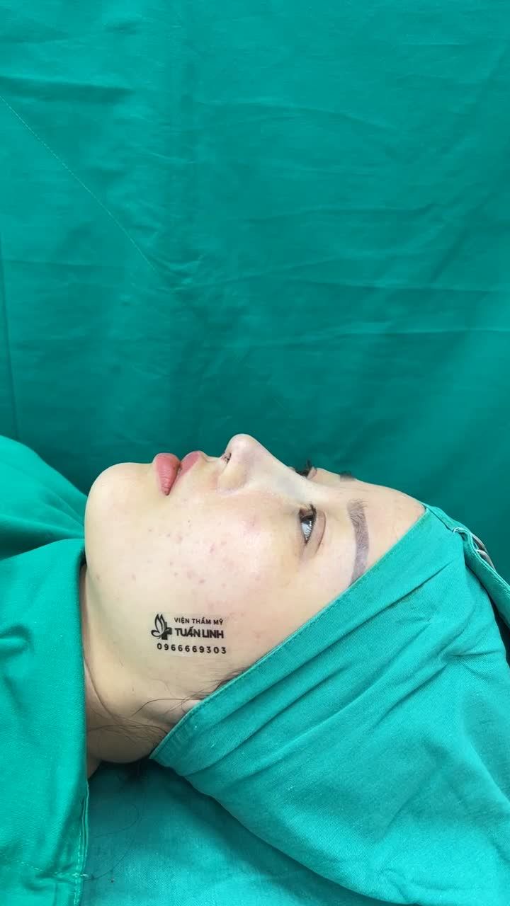 Case Nâng mũi cấu trúc + bọc megaderm đầu mũi cho khách hàng đến từ Phú Yên