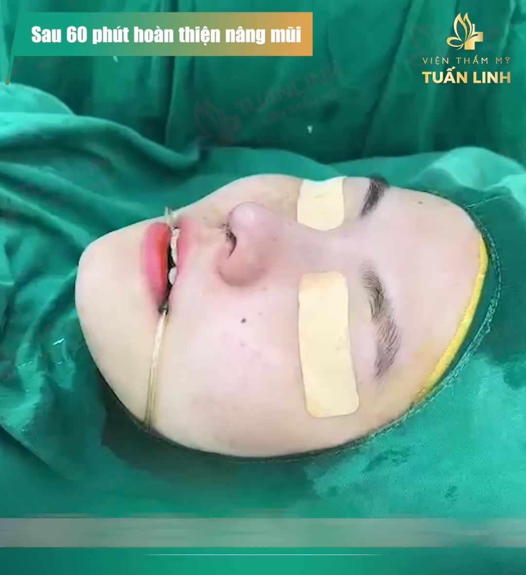 CHI TIẾT 120 PHÚT QUÁ TRÌNH NÂNG MŨI CẤU TRÚC + CẮT MÍ PLASMA
