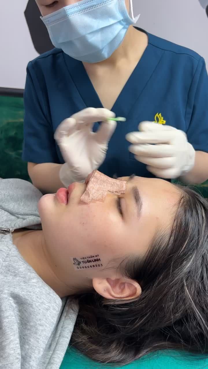 Case nâng mũi cấu trúc được 5 ngày