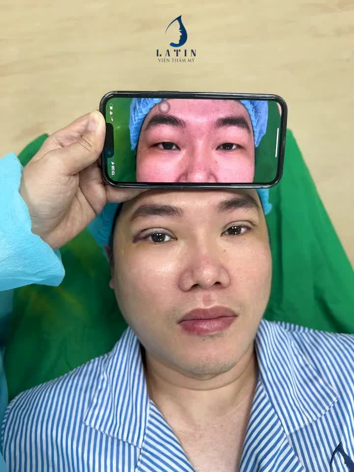 Cắt mí 4D kết hợp kéo góc mắt