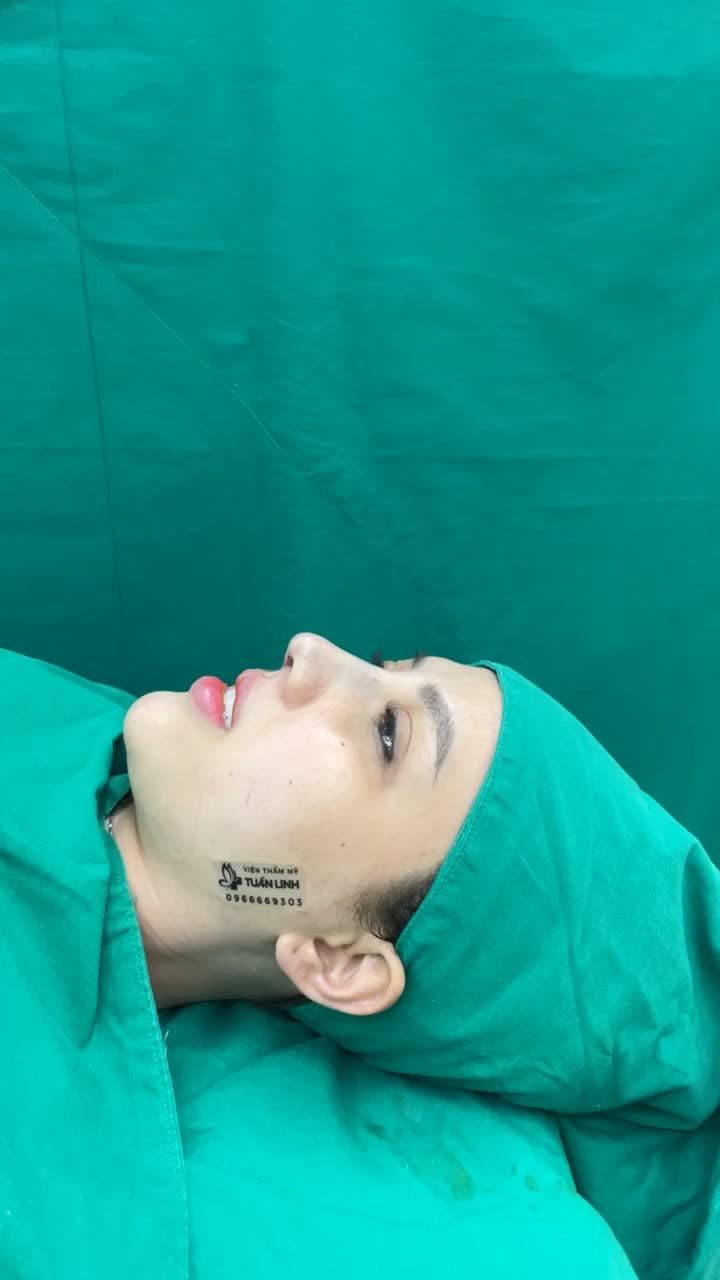 Ca nâng  mũi cuối ngày cấu trúc bọc megaderm + mài gồ của viện thẩm mỹ Tuấn Linh
