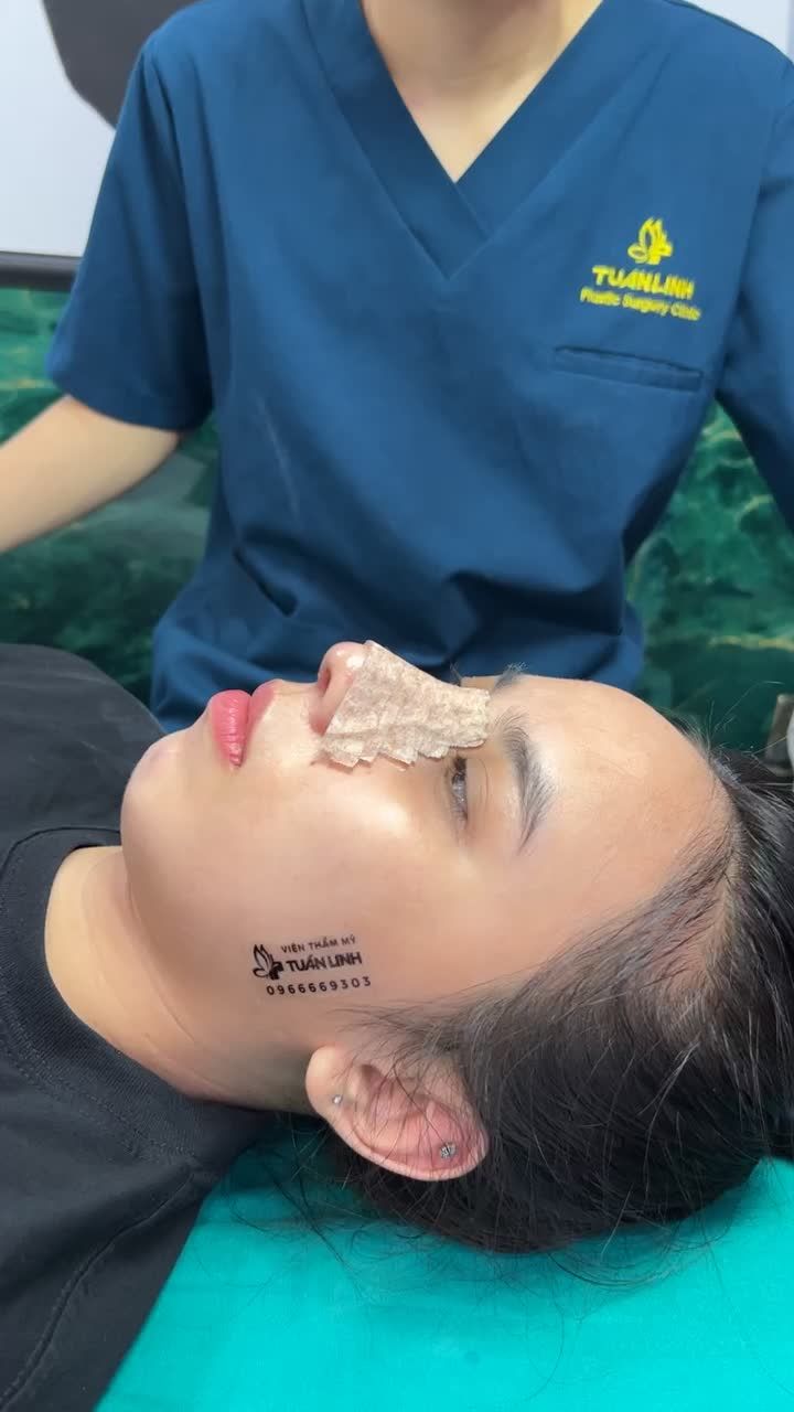 Case mũi siêu cấu trúc được 10 ngày - khách hàng đến Viện để tháo nẹp và cắt chỉ