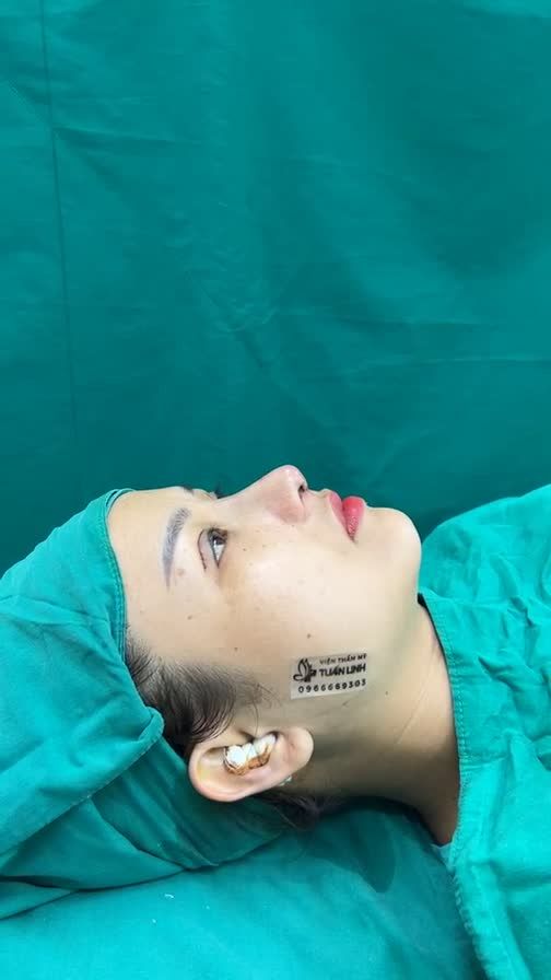 Xinh đẹp và trẻ trung hơn với combo nâng mũi + cắt mí
