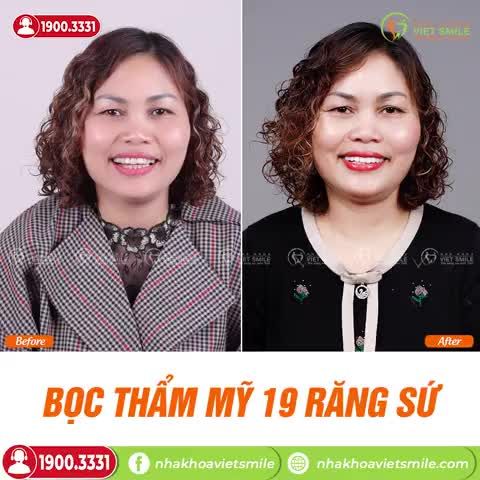 BỌC SỨ THẨM MỸ 19 RĂNG - LẤY LẠI TỰ TIN